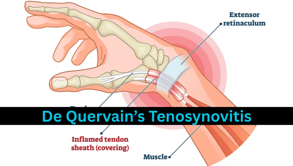 De Quervain’s Tenosynovitis