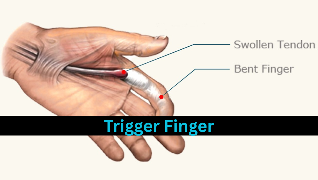 Trigger Finger