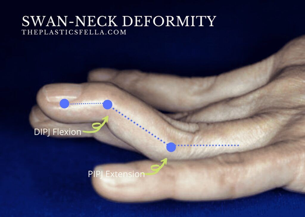 Swan Neck Deformity