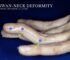 Swan Neck Deformity