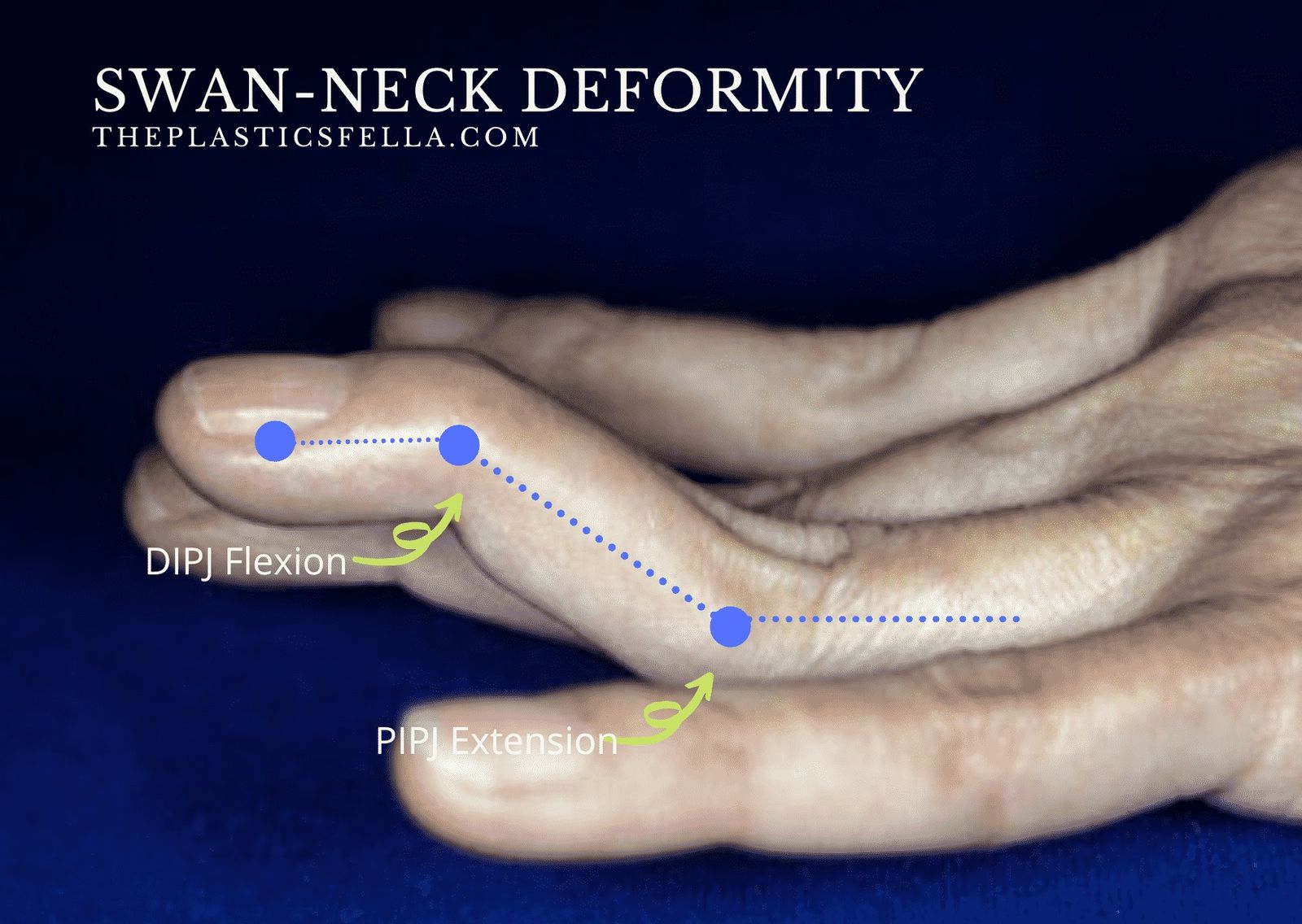 Swan Neck Deformity